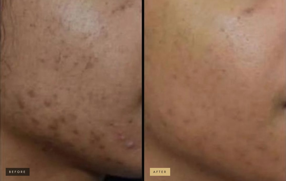 Acne marks before and after