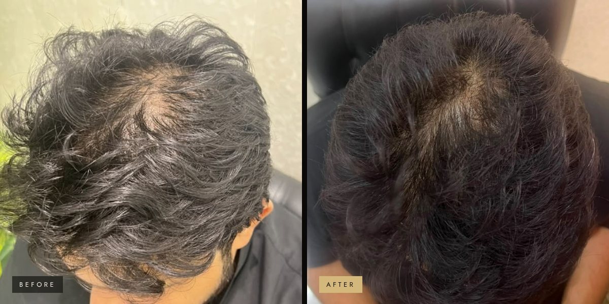 PRP hair therapy, after 3–4 sessions before and after