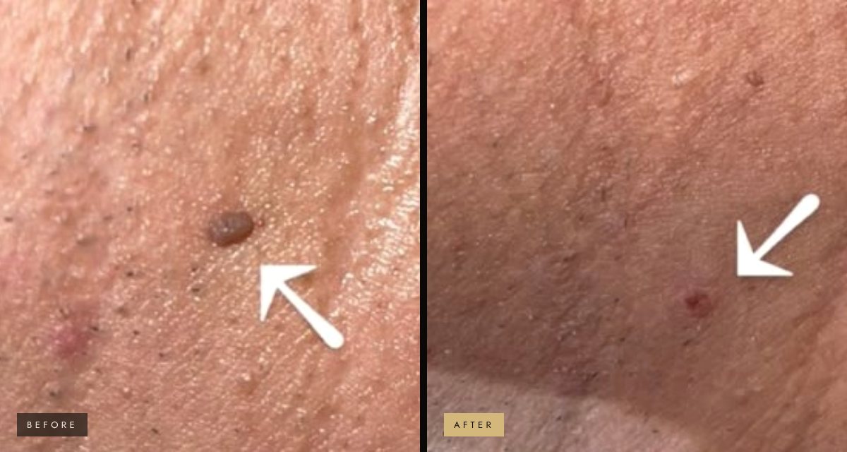 Skin tag removal before and after
