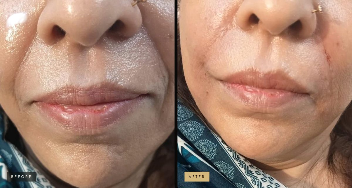 Smile-line filler before and after